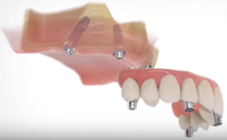 All On Four Dental Implants Long Island loading=
