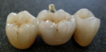 All On Four Dental Implants Long Island loading=