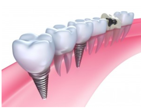 All On Four Dental Implants Long Island loading=